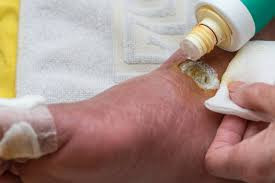 Diabetic foot dressing ₹450