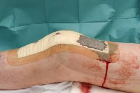 Post surgery dressing ₹450